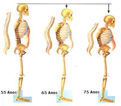 Dietas podem causar osteoporose Dietas podem causar osteoporose